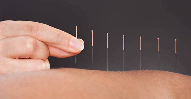 Acupuncture