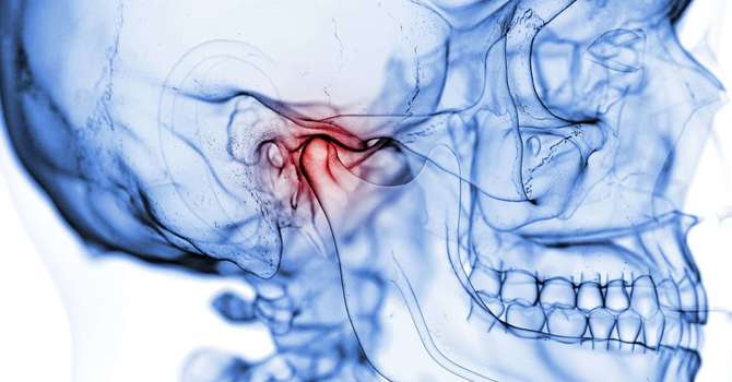 Temporomandibular Disorder (TMD) Jaw Pain image